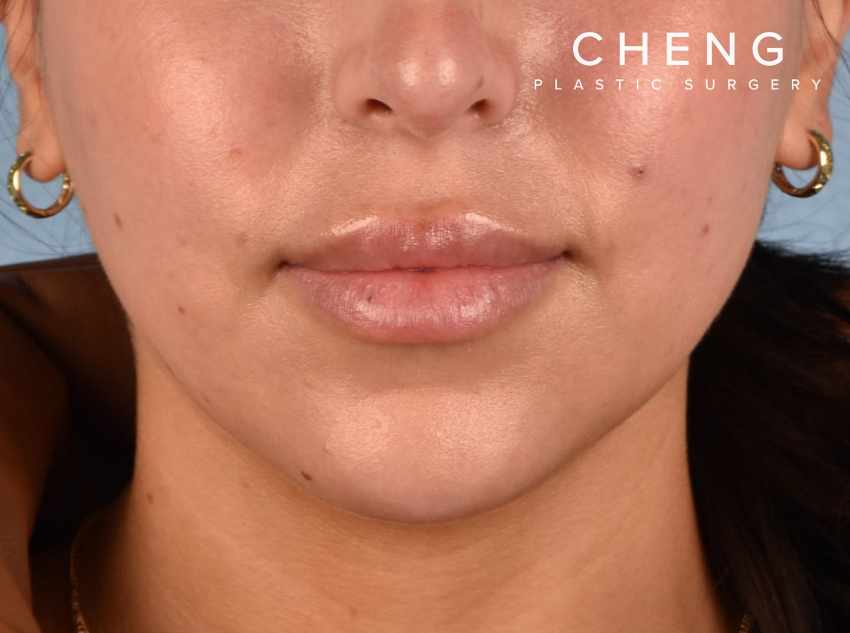 Hidden Patients Before & After Gallery - Patient 230925 - Image 2