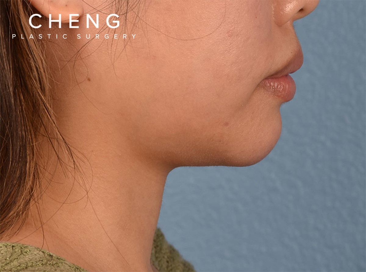 Hidden Patients Before & After Gallery - Patient 120575 - Image 1