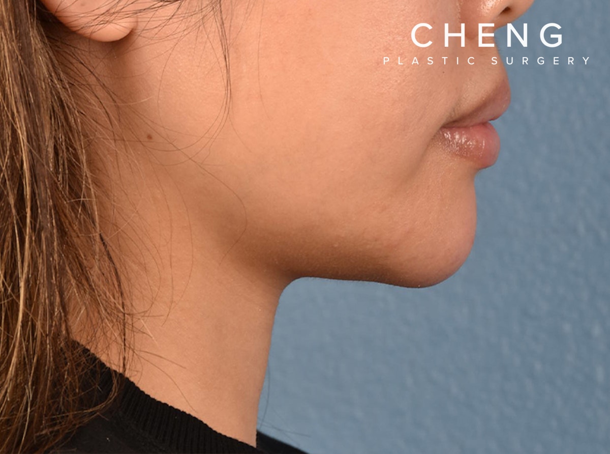 Hidden Patients Before & After Gallery - Patient 120575 - Image 2