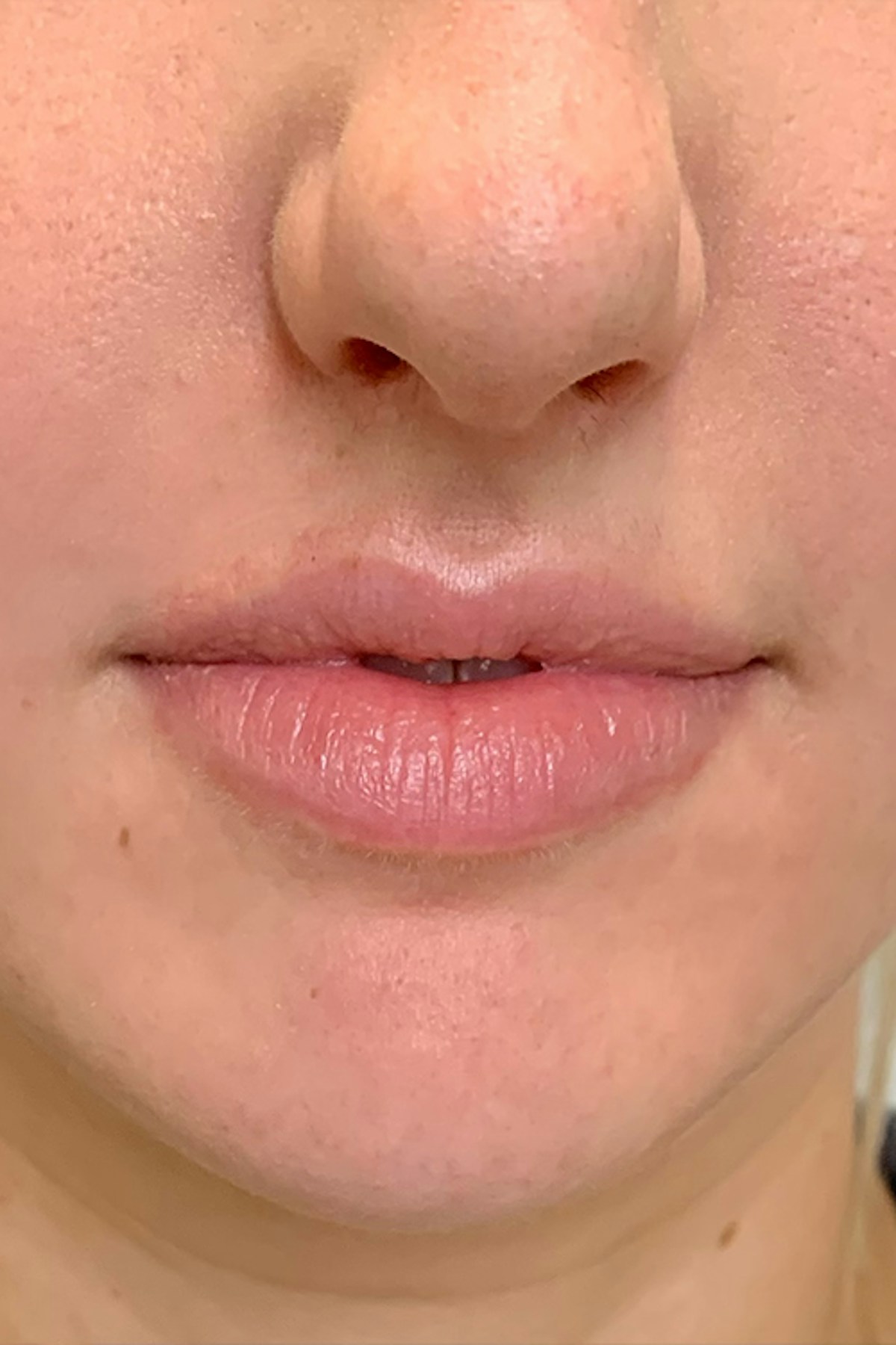 Injectables Before & After Gallery - Patient 132090 - Image 1
