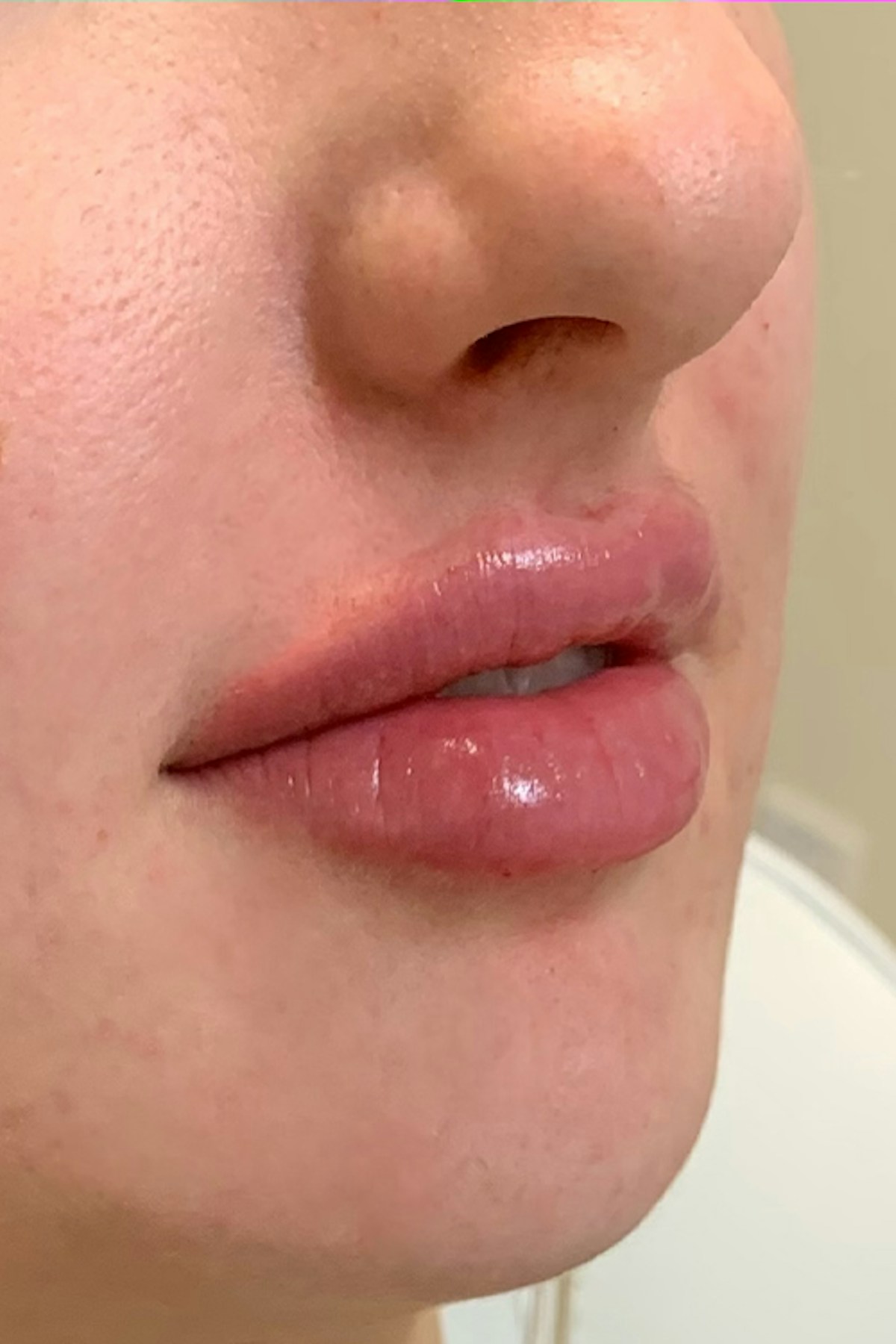 Injectables Before & After Gallery - Patient 132090 - Image 4