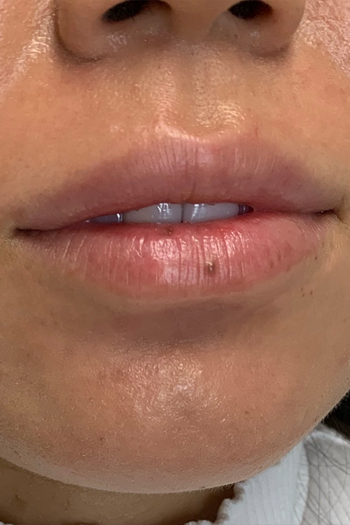 Hidden Patients Before & After Gallery - Patient 188403 - Image 1