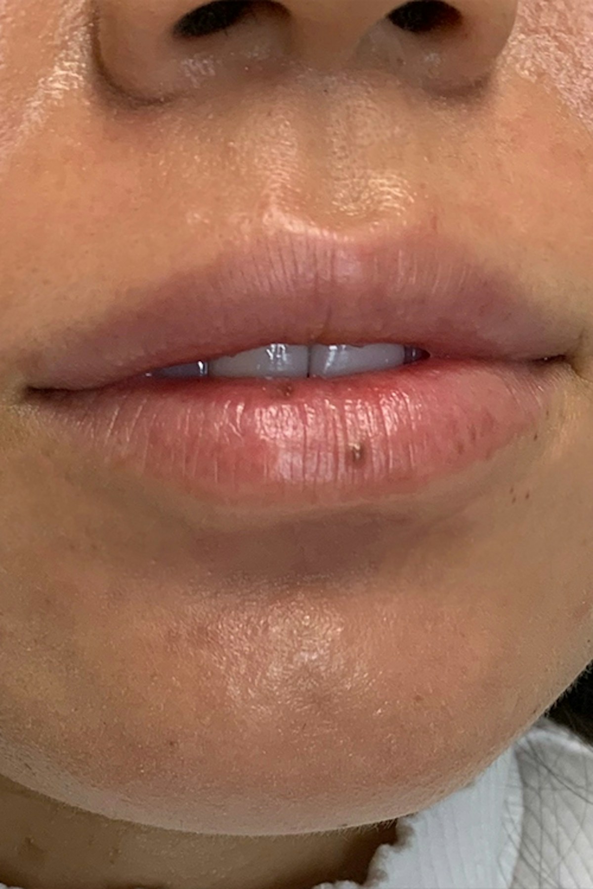 Injectables Before & After Gallery - Patient 541903 - Image 1