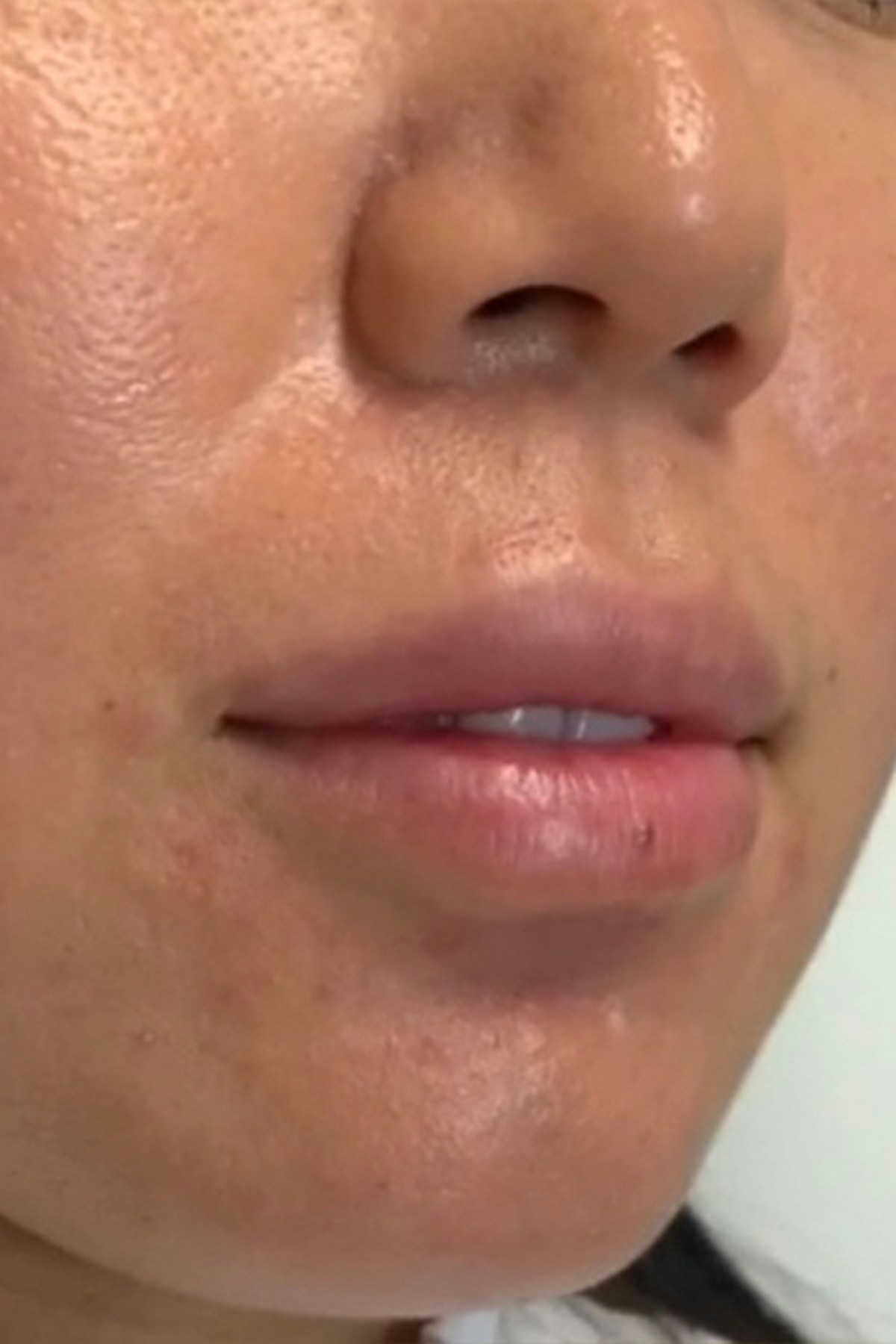Injectables Before & After Gallery - Patient 541903 - Image 3