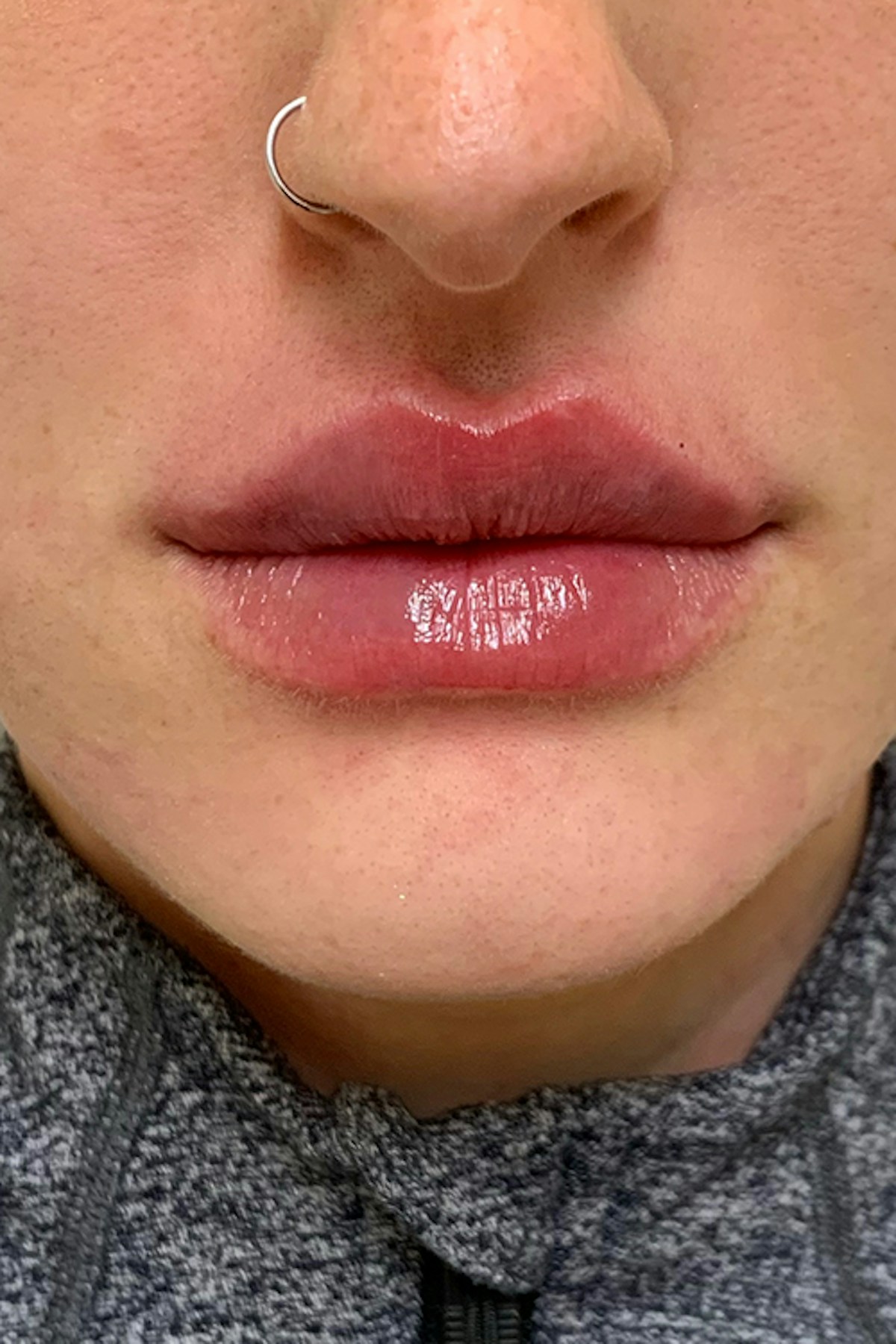 Injectables Before & After Gallery - Patient 595479 - Image 2