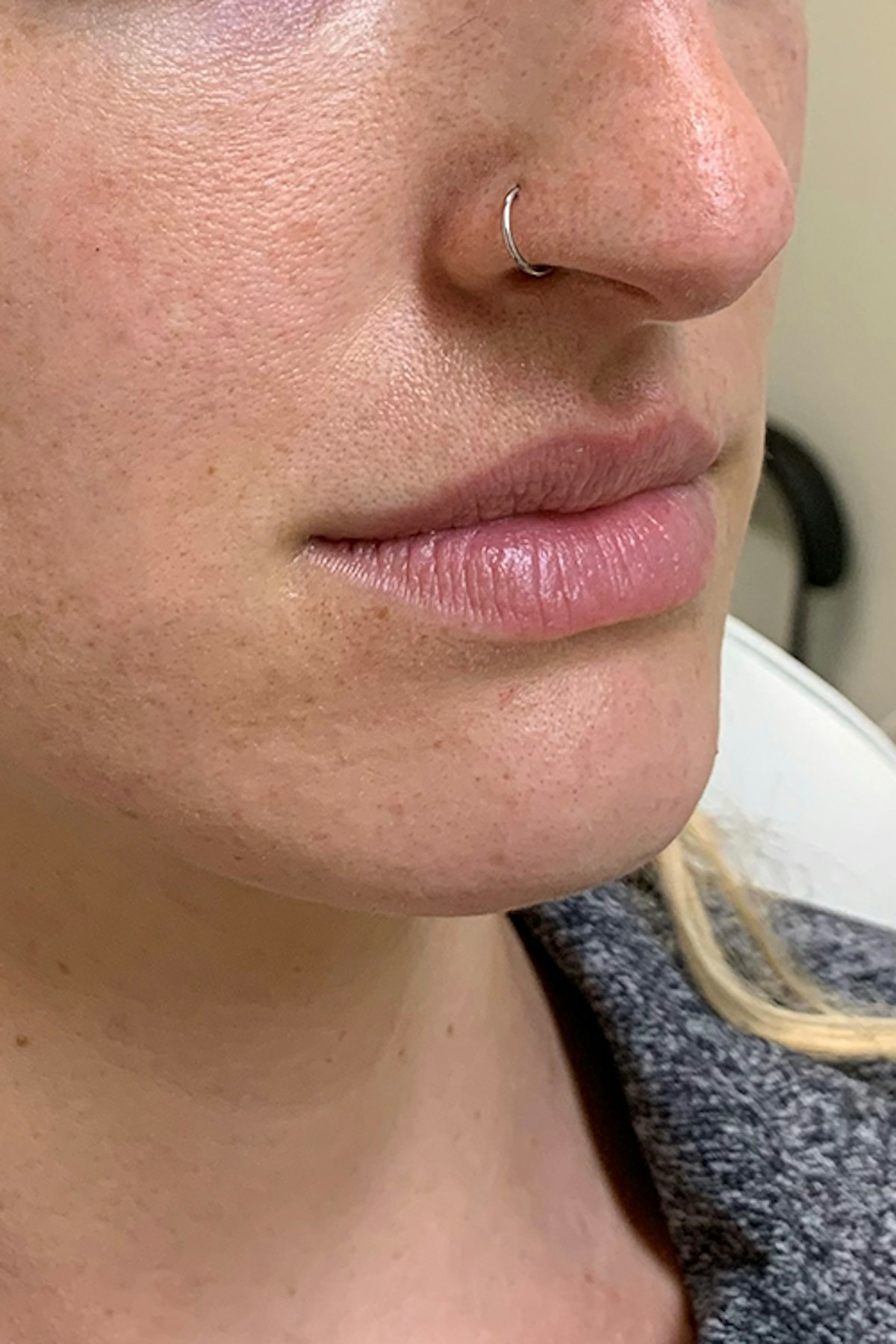 Injectables Before & After Gallery - Patient 595479 - Image 3