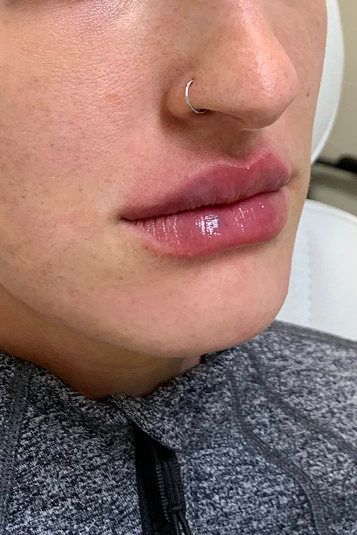 Hidden Patients Before & After Gallery - Patient 228114 - Image 4