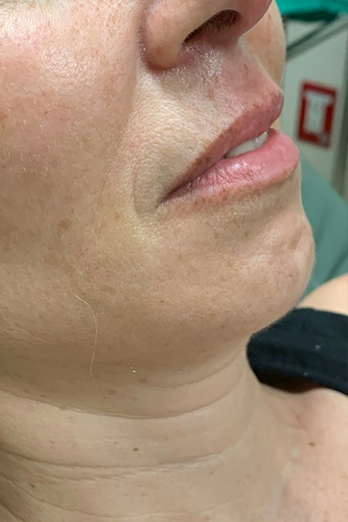 Injectables Before & After Gallery - Patient 297352 - Image 3