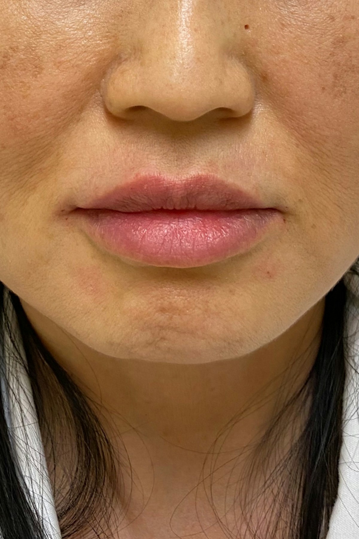 Lip Fillers Before & After Gallery - Patient 384528 - Image 2