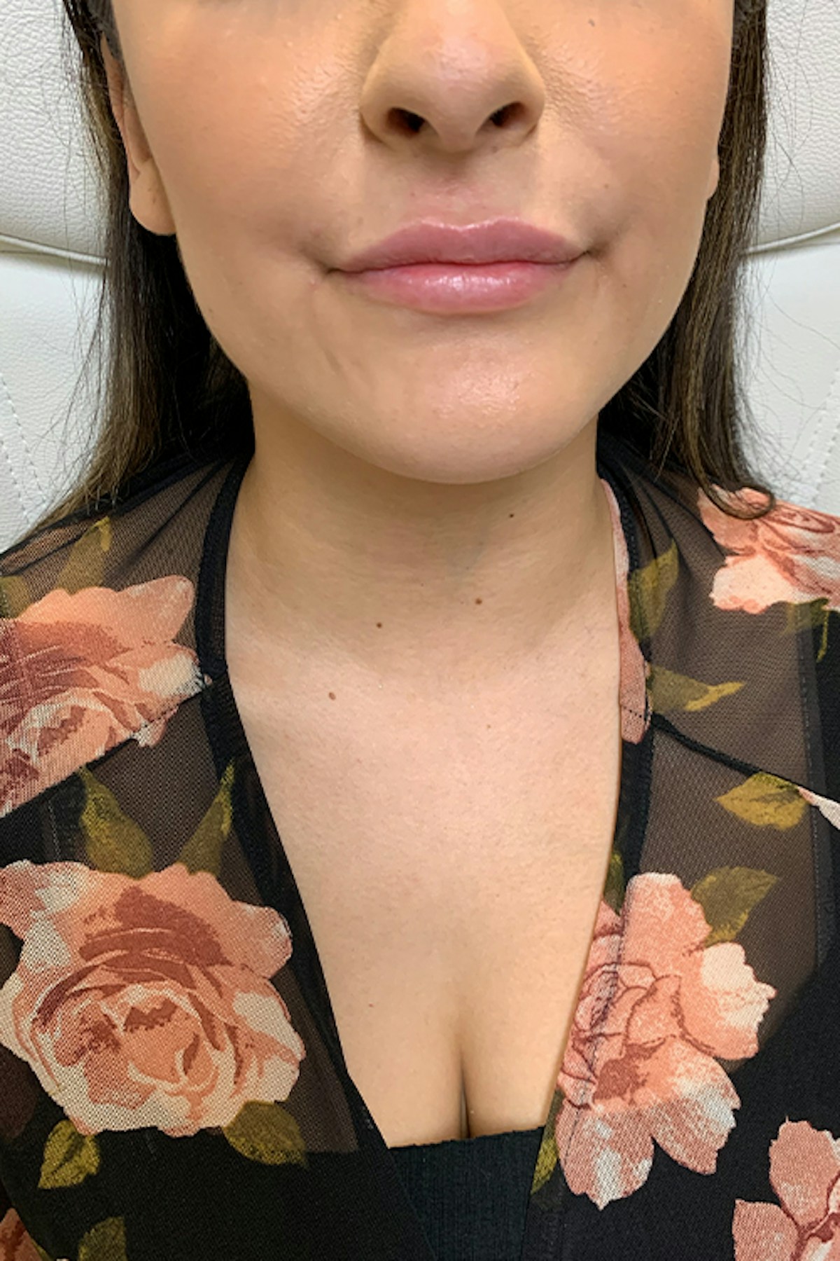 Injectables Before & After Gallery - Patient 254102 - Image 1