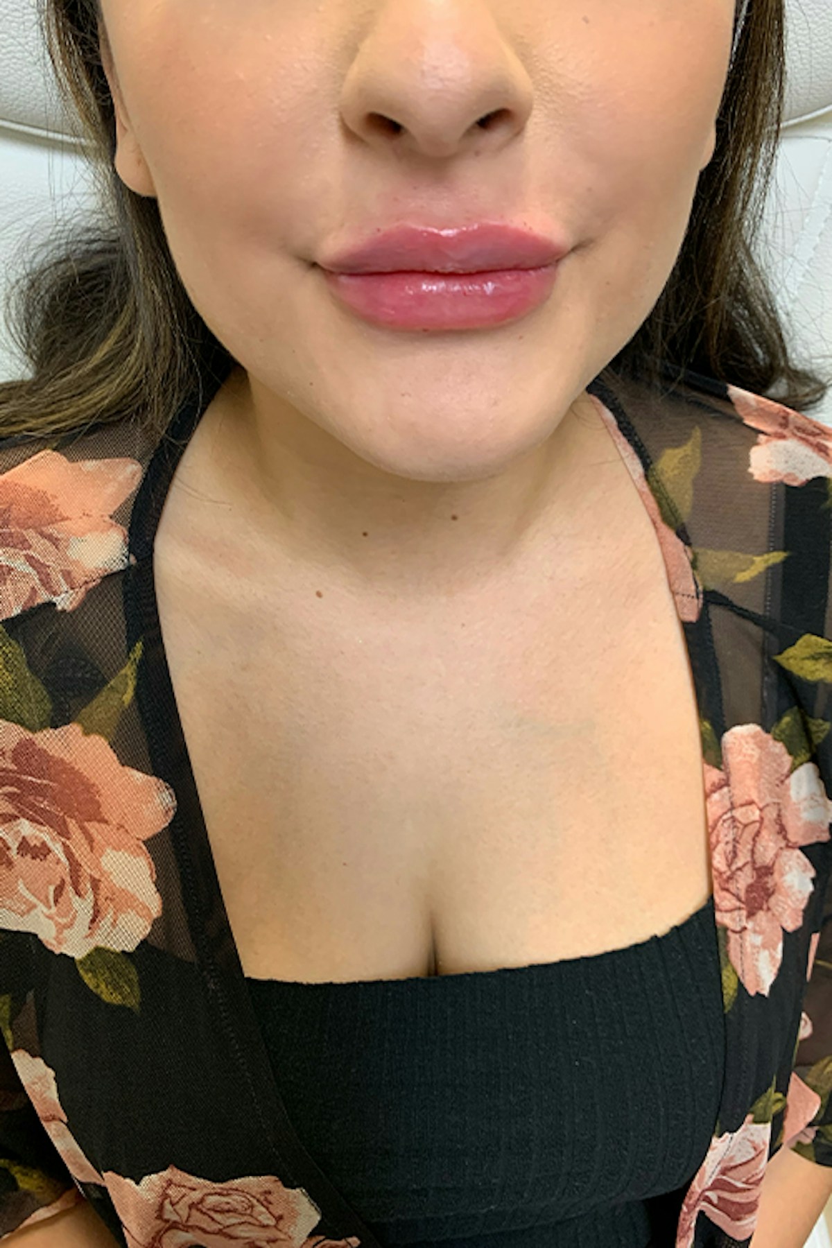 Injectables Before & After Gallery - Patient 254102 - Image 2
