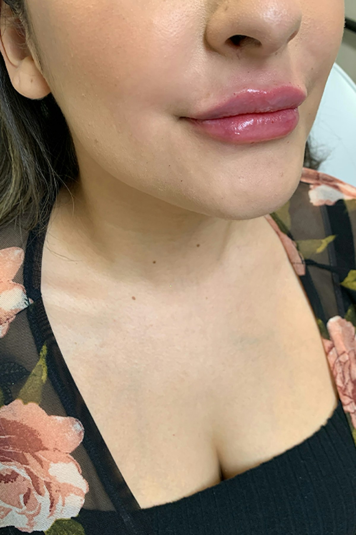 Injectables Before & After Gallery - Patient 254102 - Image 4