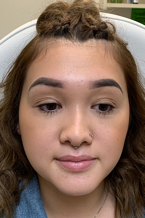 Hidden Patients Before & After Gallery - Patient 215125 - Image 3