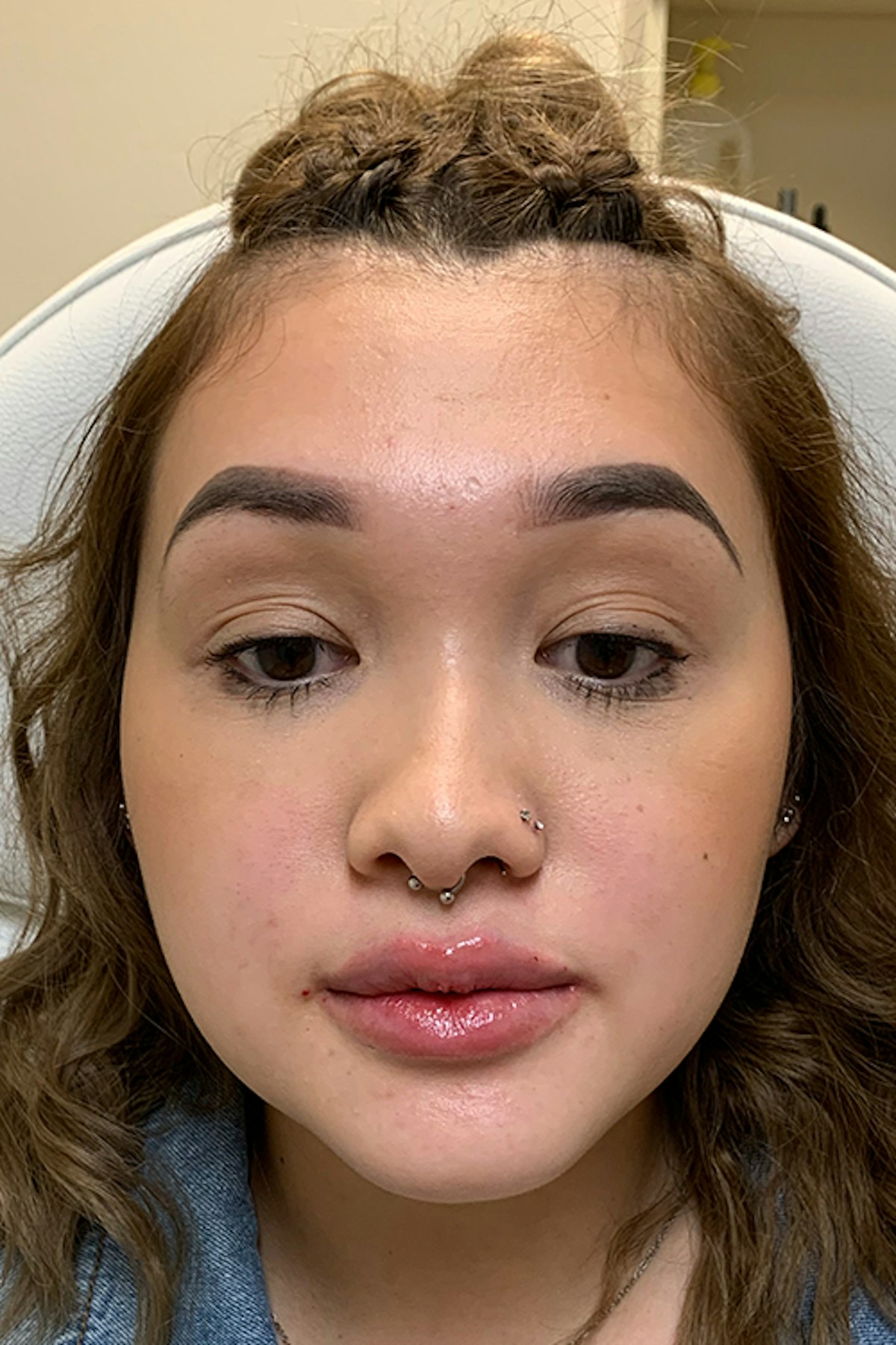 Injectables Before & After Gallery - Patient 382508 - Image 4