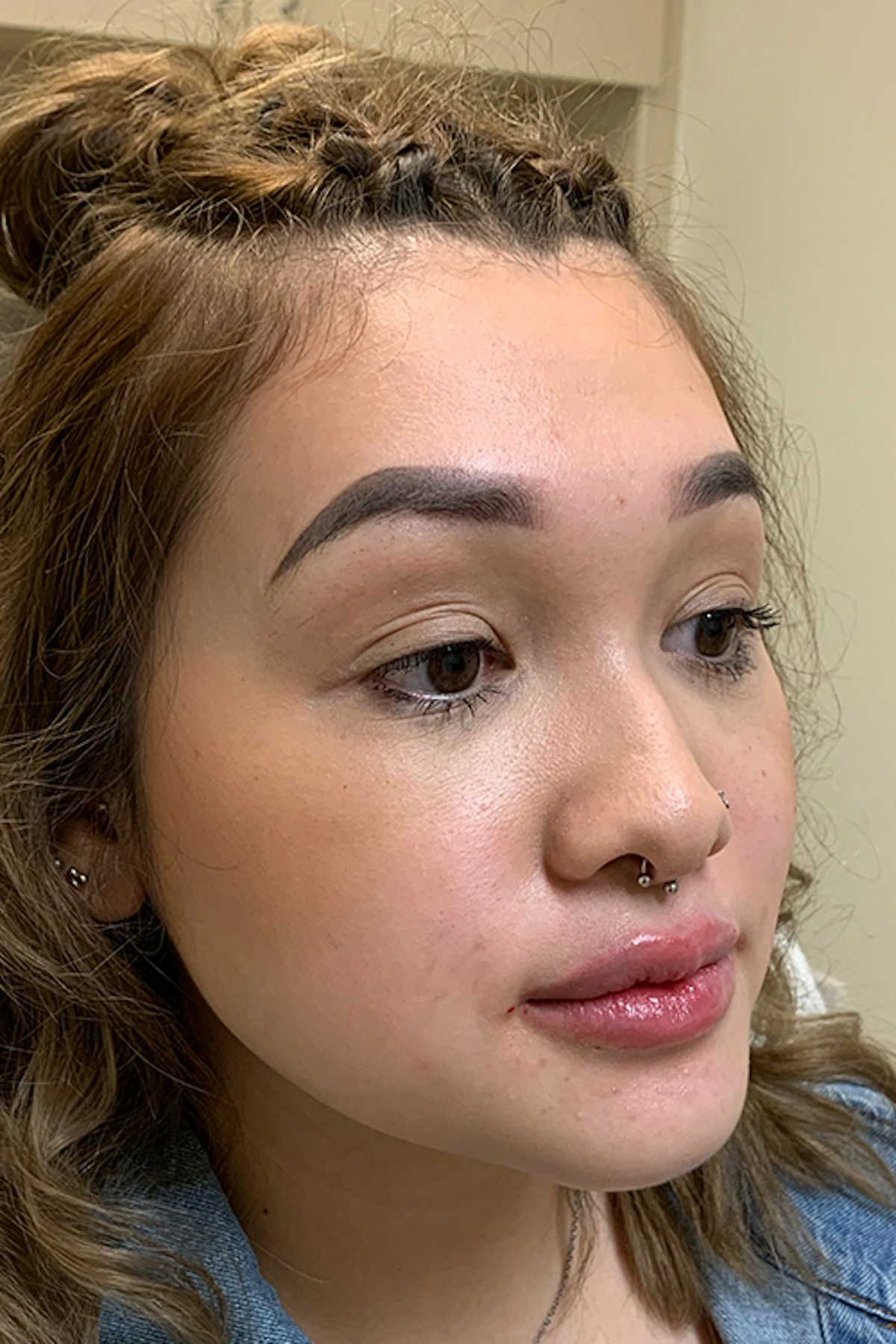 Injectables Before & After Gallery - Patient 382508 - Image 6