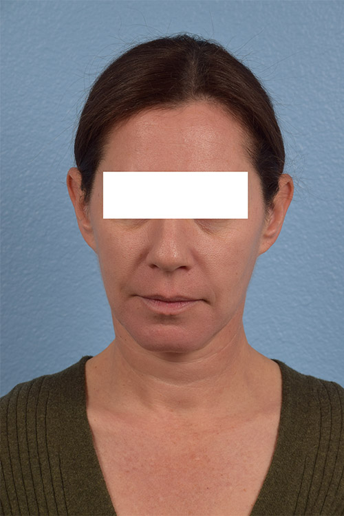 Hidden Patients Before & After Gallery - Patient 695453 - Image 1
