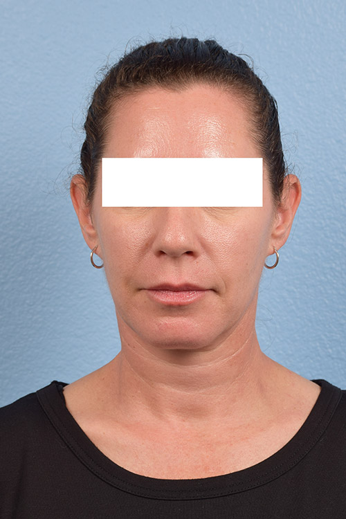 Hidden Patients Before & After Gallery - Patient 695453 - Image 2