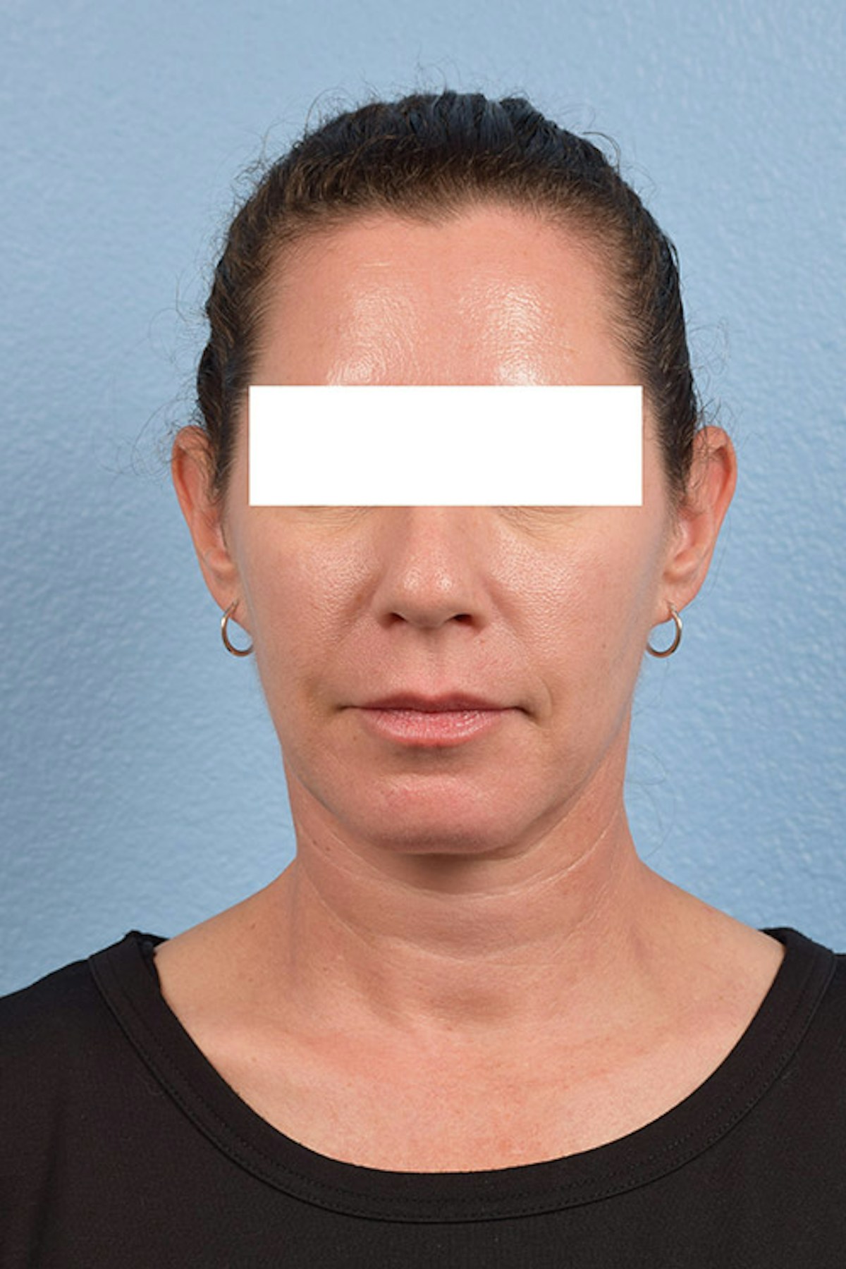 Injectables Before & After Gallery - Patient 253170 - Image 2