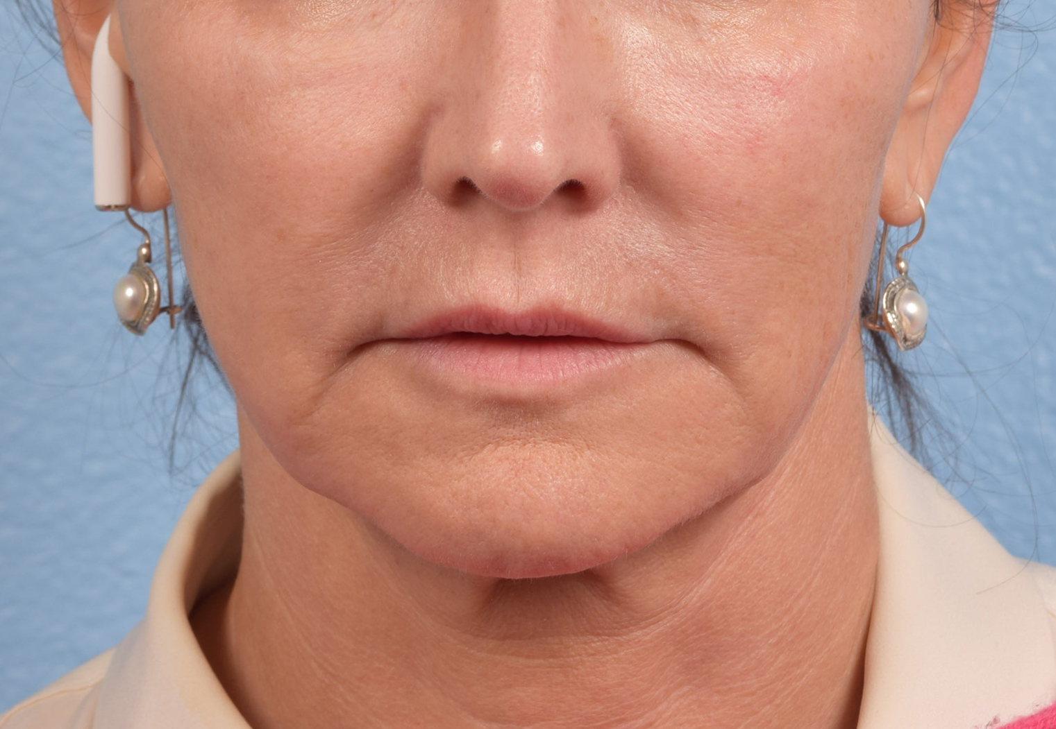 Hidden Patients Before & After Gallery - Patient 262095 - Image 1