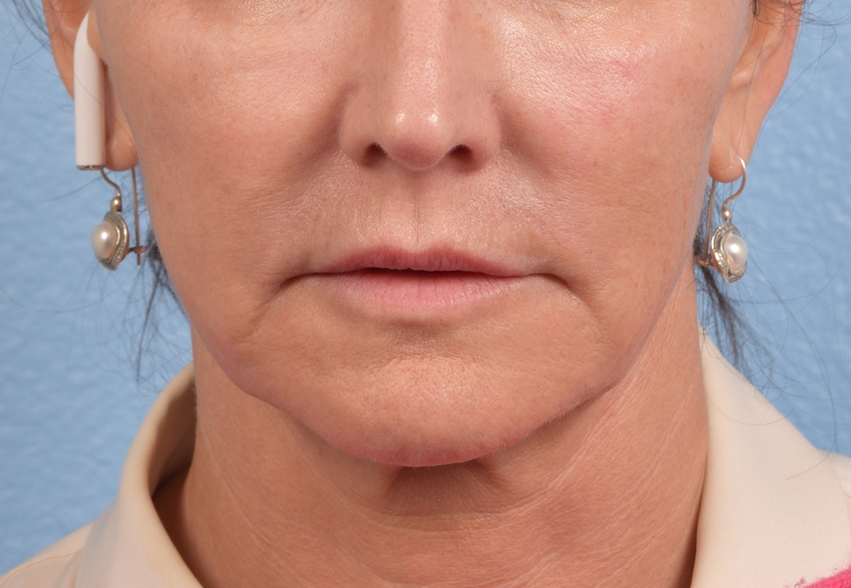 Thread Lifting Before & After Gallery - Patient 411991 - Image 1
