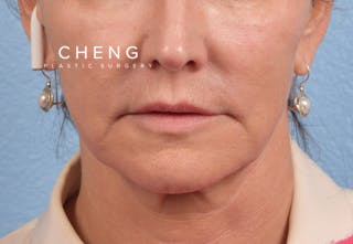 Hidden Patients Before & After Gallery - Patient 262095 - Image 1