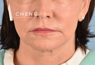 Hidden Patients Before & After Gallery - Patient 262095 - Image 2