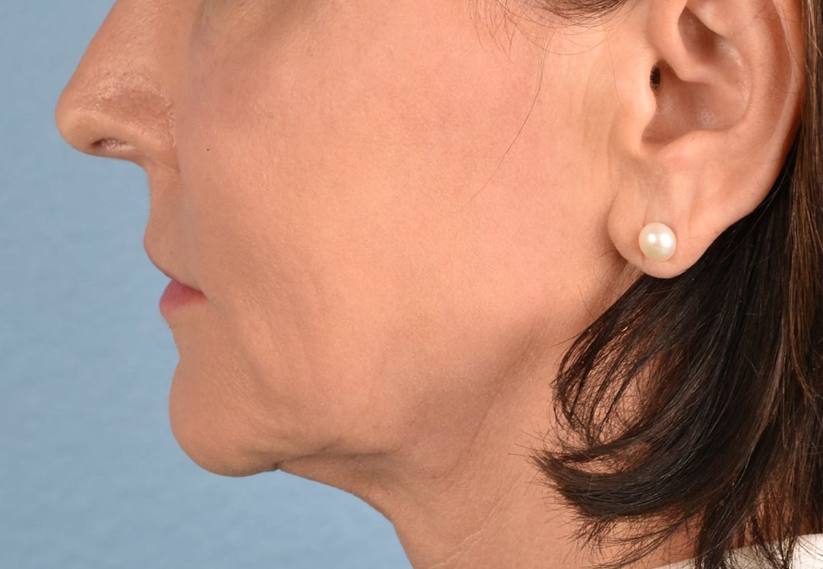 Thread Lifting Before & After Gallery - Patient 411991 - Image 4