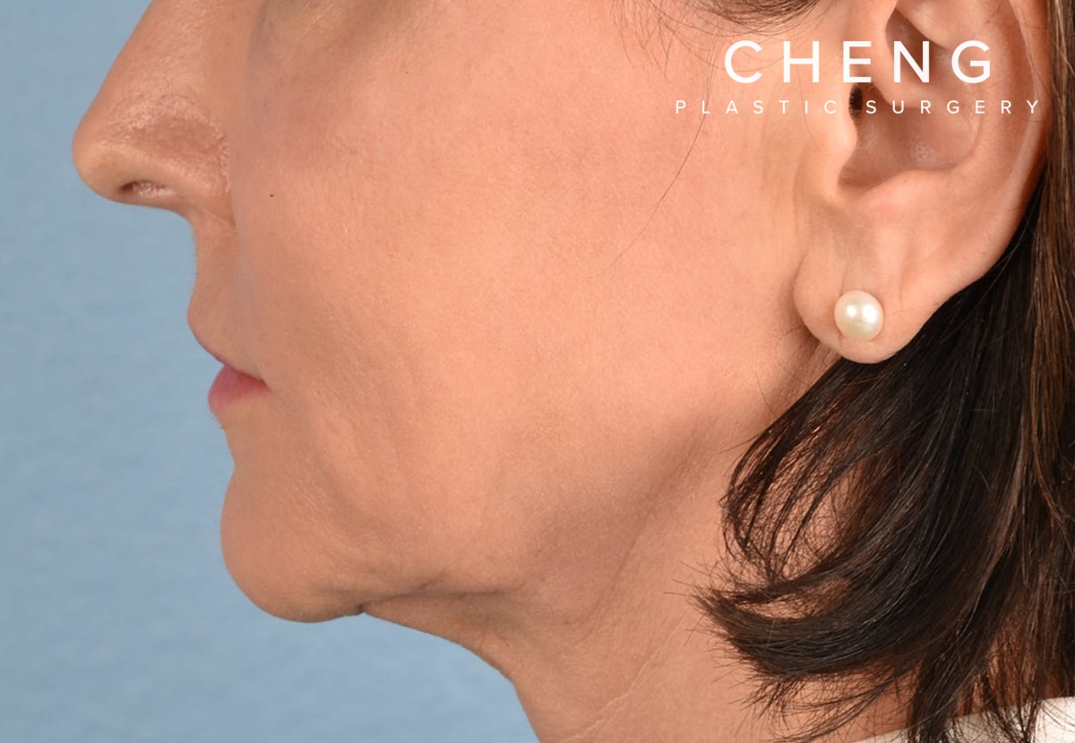 Hidden Patients Before & After Gallery - Patient 262095 - Image 4