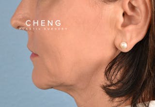 Hidden Patients Before & After Gallery - Patient 262095 - Image 4