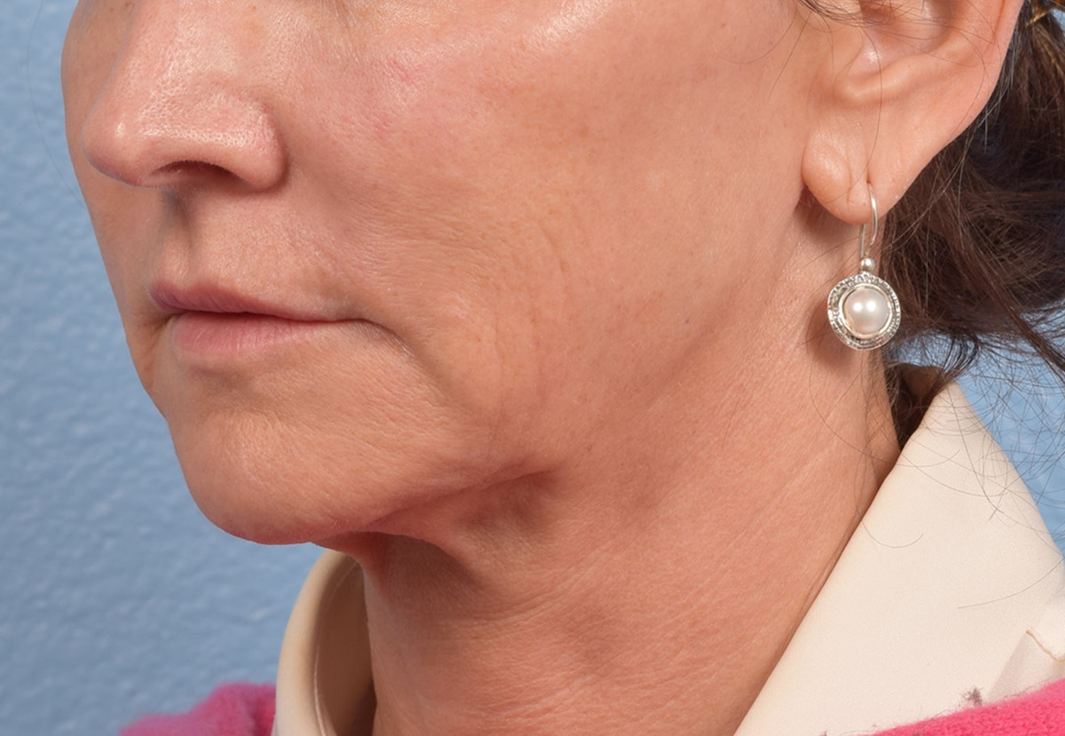 Thread Lifting Before & After Gallery - Patient 411991 - Image 5