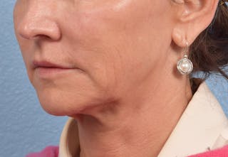 Hidden Patients Before & After Gallery - Patient 262095 - Image 5