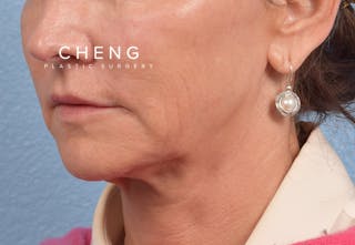 Hidden Patients Before & After Gallery - Patient 262095 - Image 5