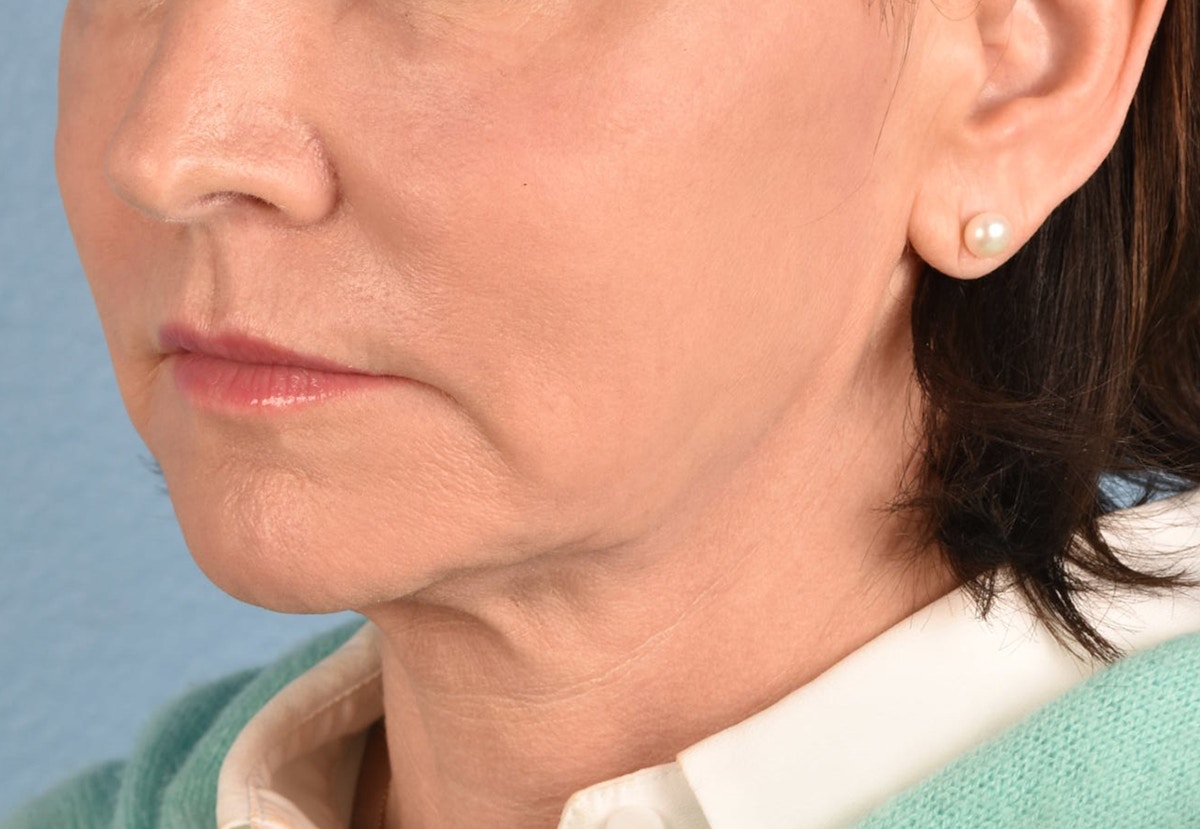 Thread Lifting Before & After Gallery - Patient 411991 - Image 6