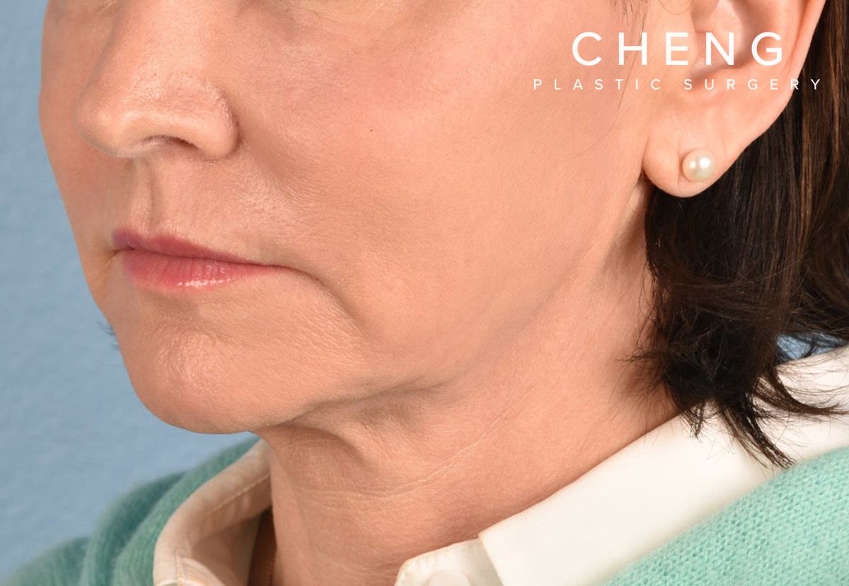 Hidden Patients Before & After Gallery - Patient 262095 - Image 6