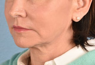 Hidden Patients Before & After Gallery - Patient 262095 - Image 6