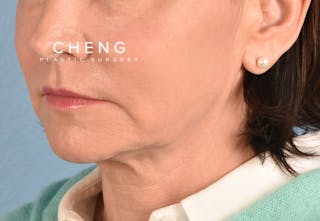 Hidden Patients Before & After Gallery - Patient 262095 - Image 6