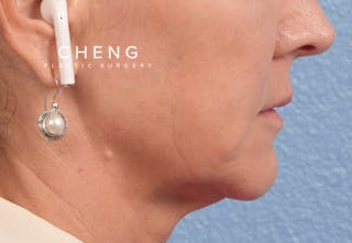 Hidden Patients Before & After Gallery - Patient 262095 - Image 7