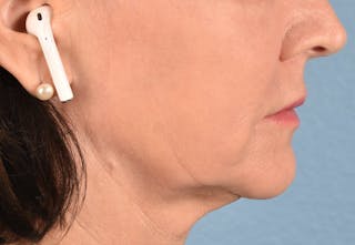 Hidden Patients Before & After Gallery - Patient 262095 - Image 8