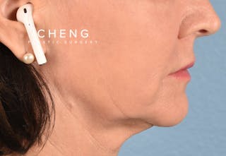 Hidden Patients Before & After Gallery - Patient 262095 - Image 8