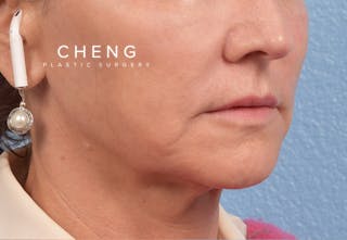 Hidden Patients Before & After Gallery - Patient 262095 - Image 9