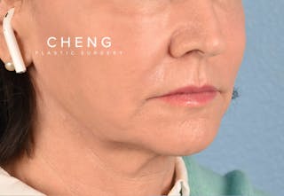 Hidden Patients Before & After Gallery - Patient 262095 - Image 10