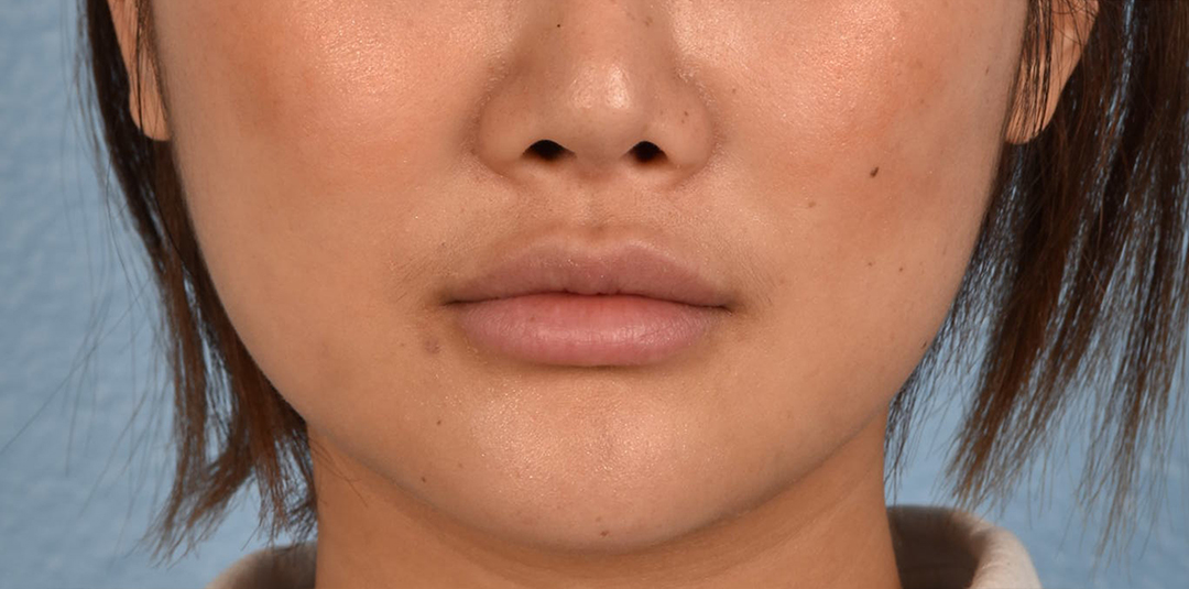 Thread Lifting Before & After Gallery - Patient 132694 - Image 2