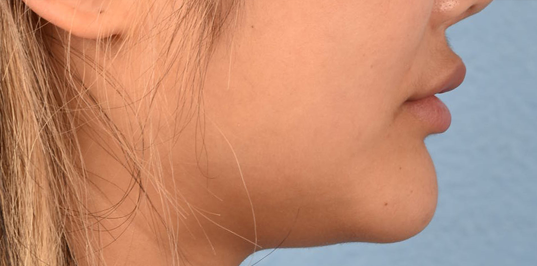 Thread Lifting Before & After Gallery - Patient 132694 - Image 3