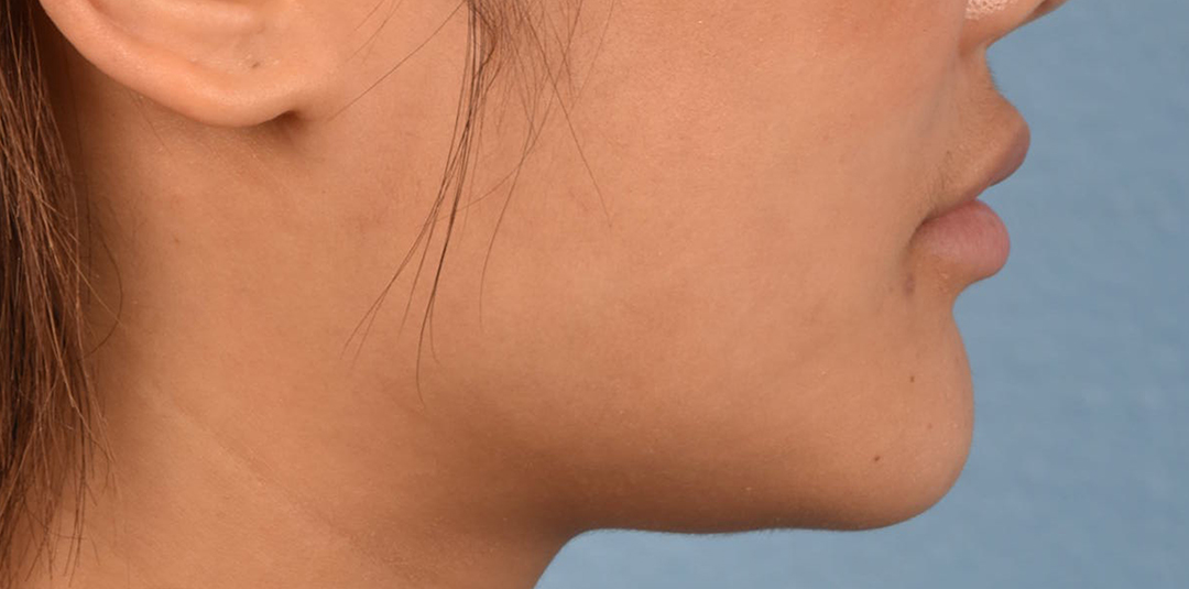 Thread Lifting Before & After Gallery - Patient 132694 - Image 4