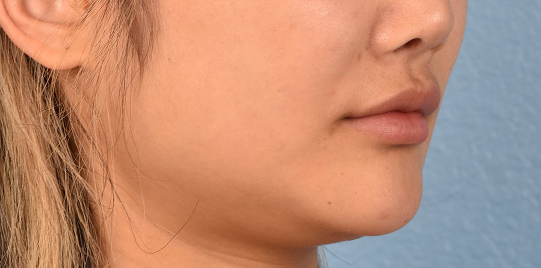 Thread Lifting Before & After Gallery - Patient 132694 - Image 5