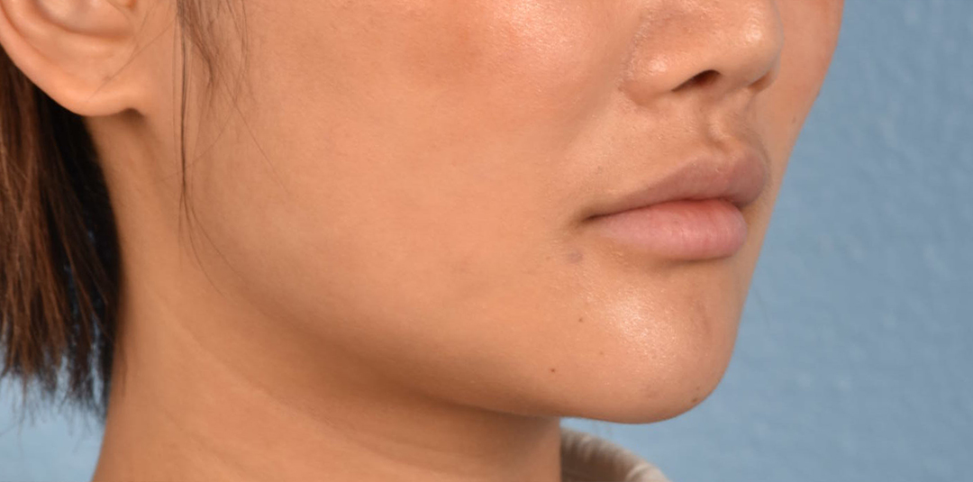 Thread Lifting Before & After Gallery - Patient 132694 - Image 6