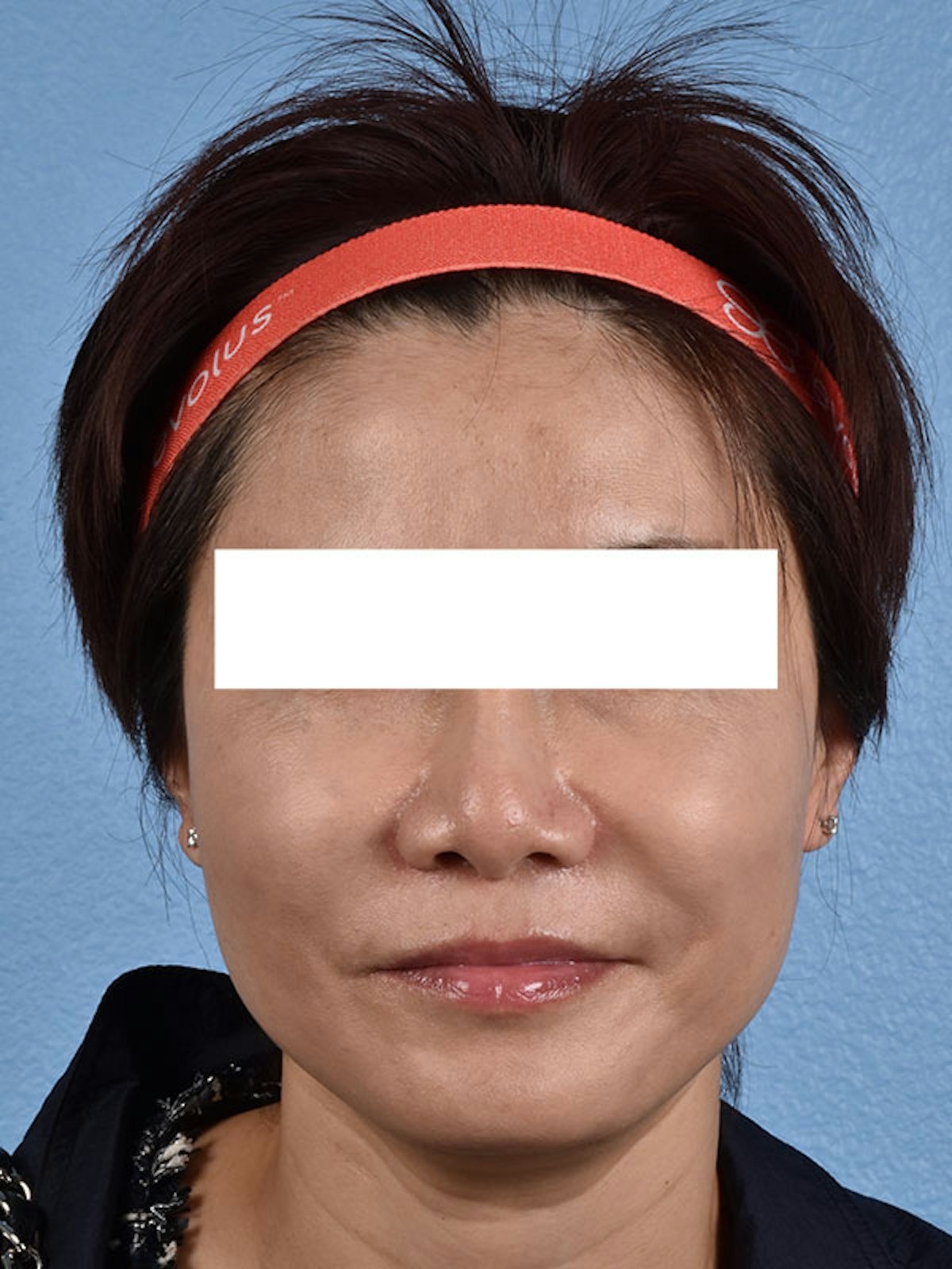 Thread Lifting Before & After Gallery - Patient 285819 - Image 1