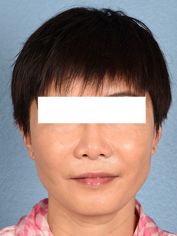 Thread Lifting Before & After Gallery - Patient 285819 - Image 2