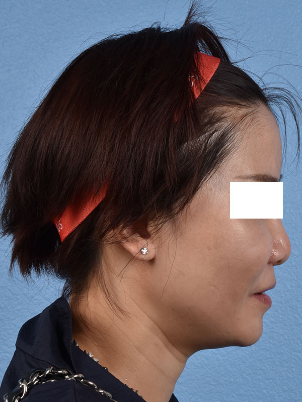 Thread Lifting Before & After Gallery - Patient 285819 - Image 3