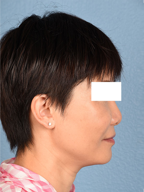 Thread Lifting Before & After Gallery - Patient 285819 - Image 4